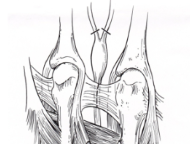 Mortons Neuroma And Intermetatarsal Bursitis Dr Hamish Curry Foot 